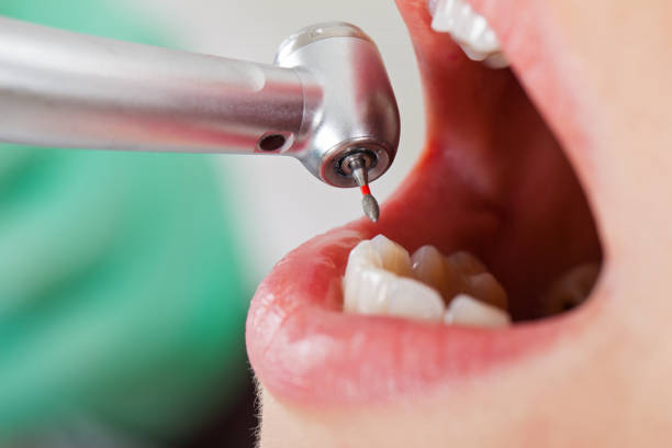 Best Emergency Tooth Extraction in Warwick, RI
